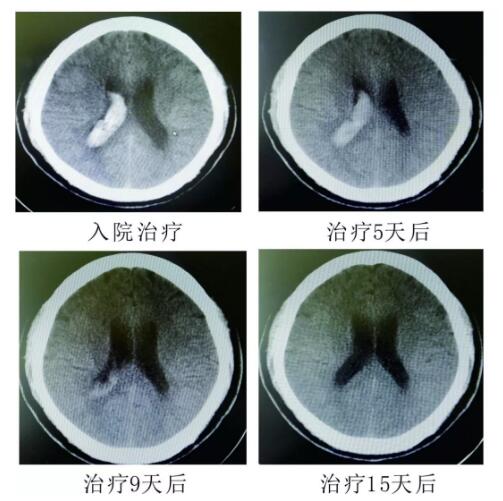 腦出血你不得不引起重視的疾?。。?！