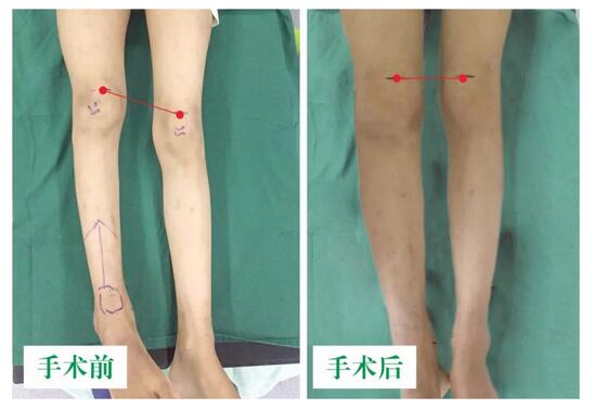 女孩墜梯右腿縮短5cm，幸得醫(yī)生及時診治恢復(fù)正常腿型