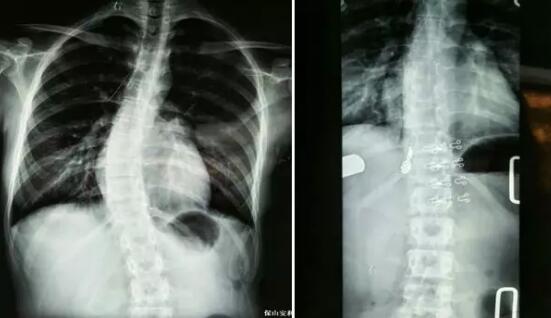 好好的脊柱怎么說彎就彎了？你竟然都沒發(fā)現(xiàn)……
