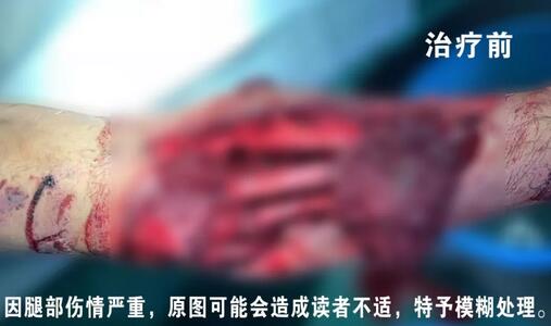 感謝安利醫(yī)院挽救了我的腿，沒(méi)有讓我落下殘疾……”
