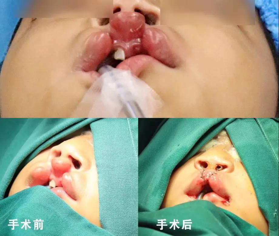 唇腭裂盡早治療消除孩子自卑心理，快樂成長！
