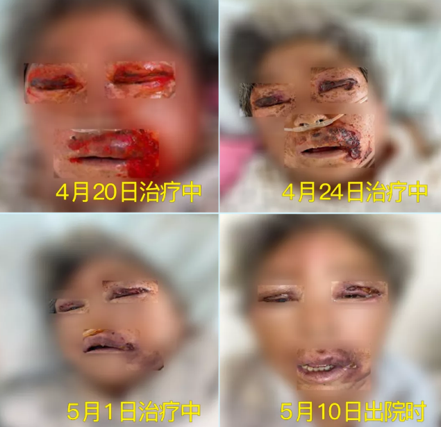膿毒血癥（急性頜面部蜂窩組織炎）多學科聯(lián)合會診，幫助患者成功治愈！