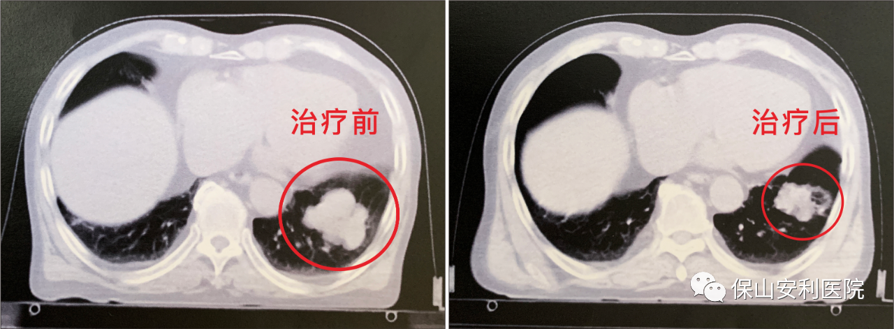不做手術，早期肺癌也能根治！