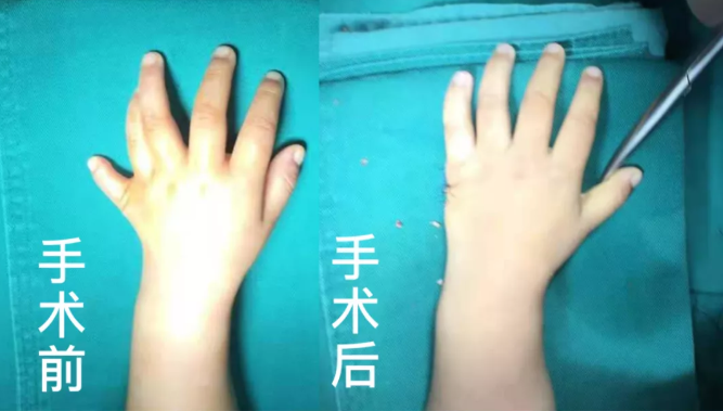 【保山安利醫(yī)院】2歲小兒手、足多指（趾）成功修復(fù)(矯正）！