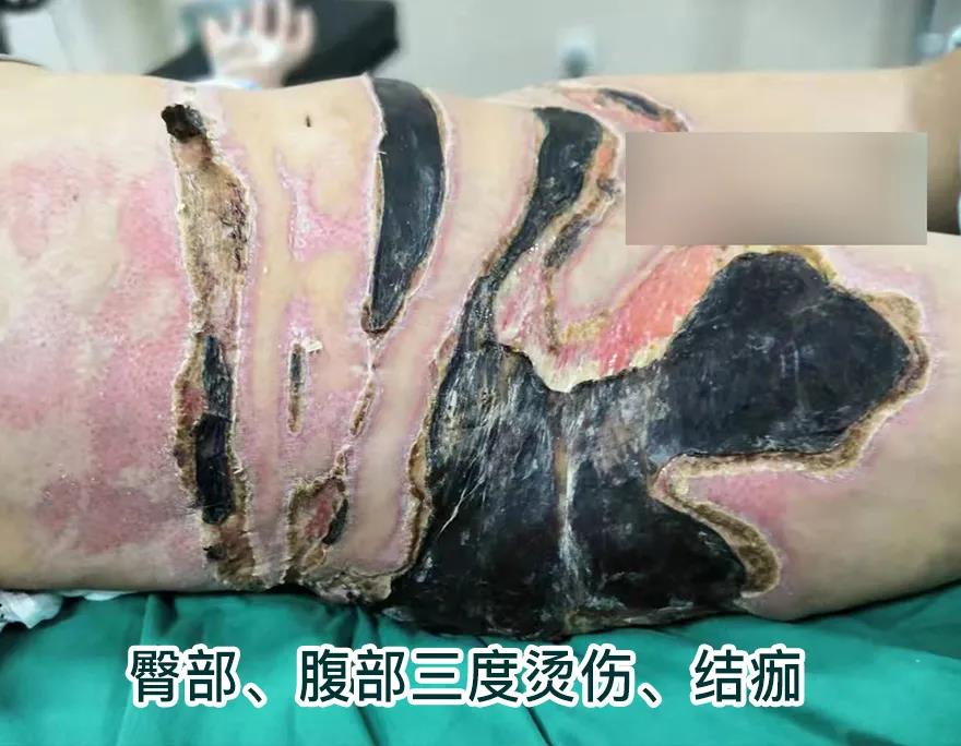 【保山安利醫(yī)院】80歲老人不慎燒傷，導(dǎo)致腹部、右側(cè)臀部大面積創(chuàng)傷，經(jīng)植皮治療創(chuàng)面逐漸愈合