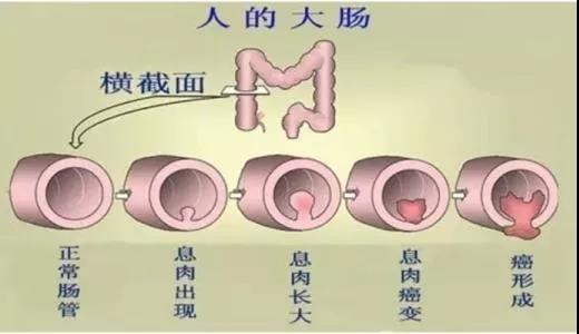 體檢發(fā)現(xiàn)腸息肉會癌變嗎？