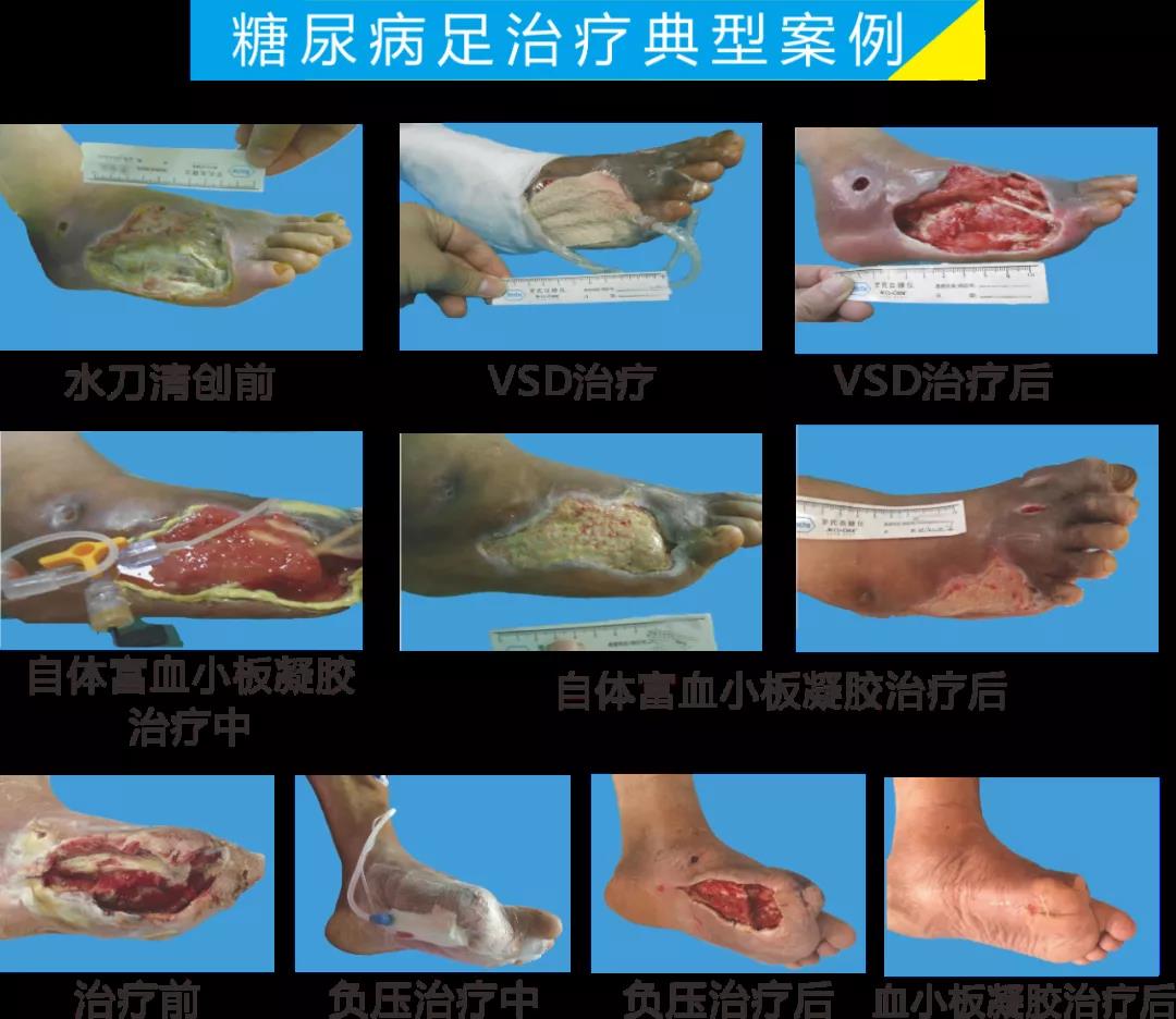 截肢、失明，甚至……，我們要做的是將糖尿病并發(fā)癥遏制在搖籃里！