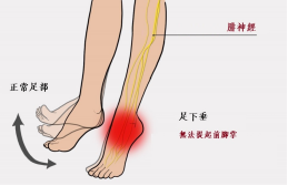 【保山安利醫(yī)院—健康科普】什么是足下垂！你了解嗎？