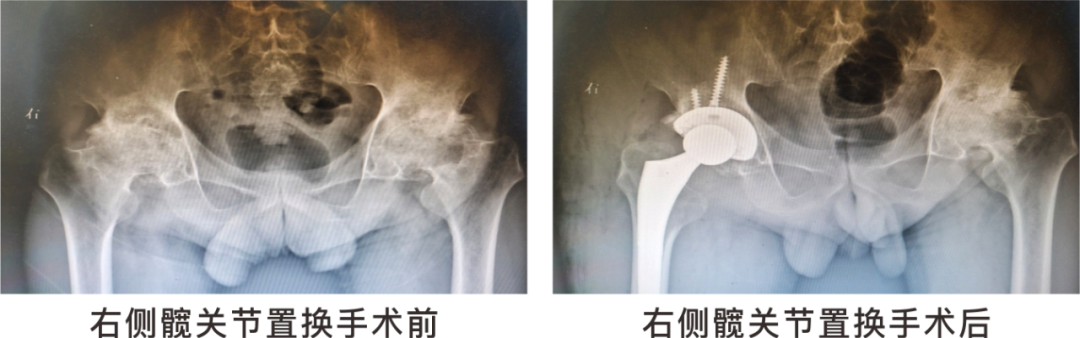 【保山安利醫(yī)院】長(zhǎng)期飲酒導(dǎo)致雙側(cè)股骨頭壞死，髖關(guān)節(jié)置換后重獲運(yùn)動(dòng)功能！
